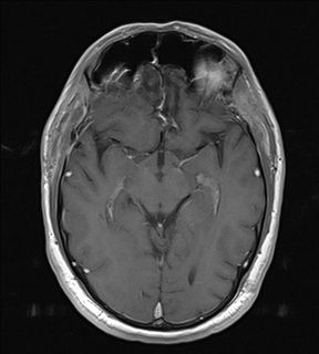 RM Cerebral mostrando la extirpación de los angiomas cavernosos.
