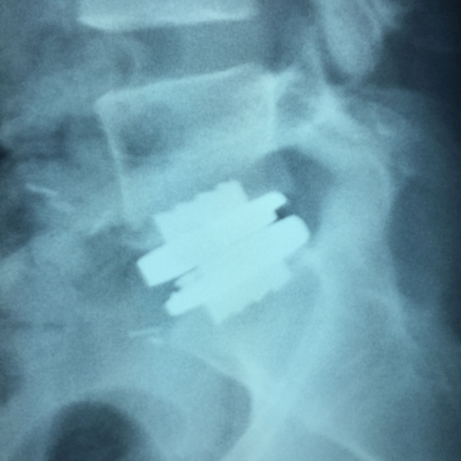 Radiografia de control tras Artroplastia Discal en L5-S1