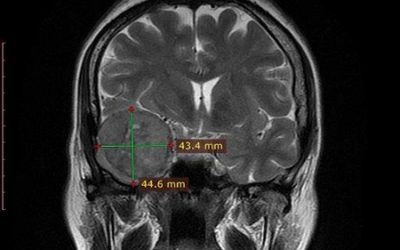 Meningioma temporal derecho