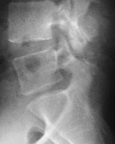 Radiografia lateral