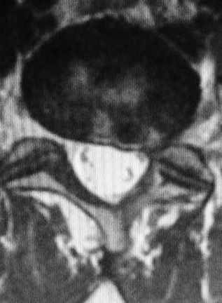 Resonancia Magnética axial con hernia del núcleo pulposo