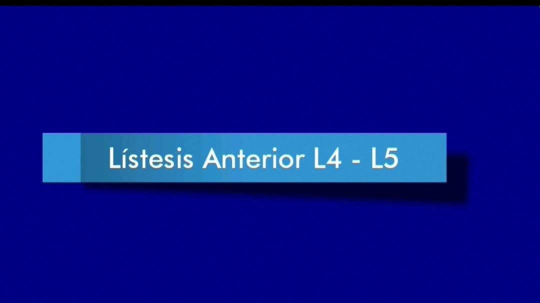 Listesis Lumbar en L4 L5